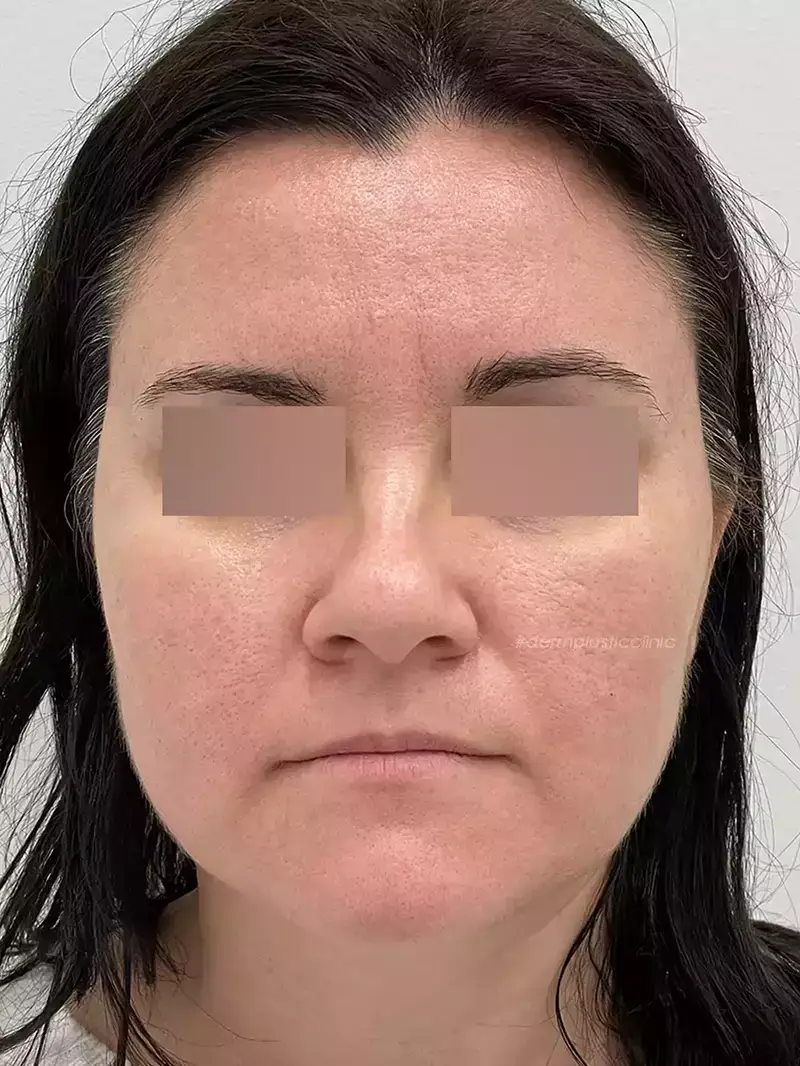 Χημικό Peeling Φωτογραφία Μετά