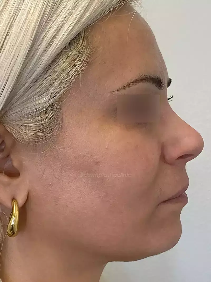 Χημικό Peeling Φωτογραφία Μετά