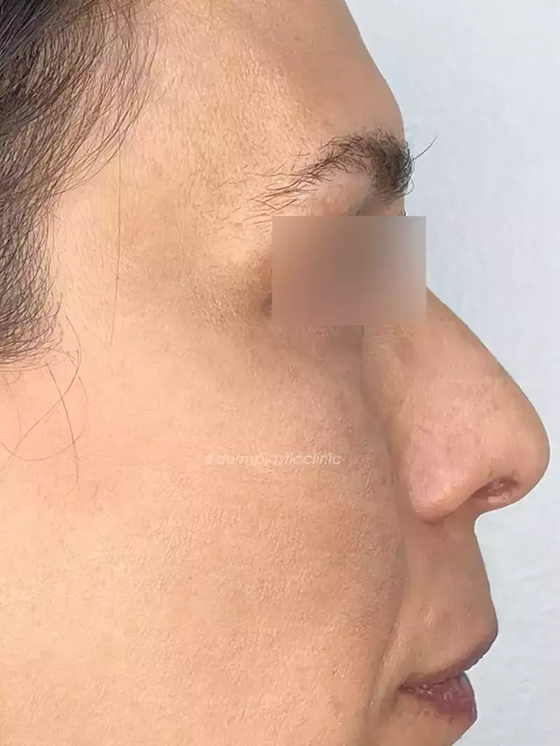 Χημικό Peeling Φωτογραφία Μετά