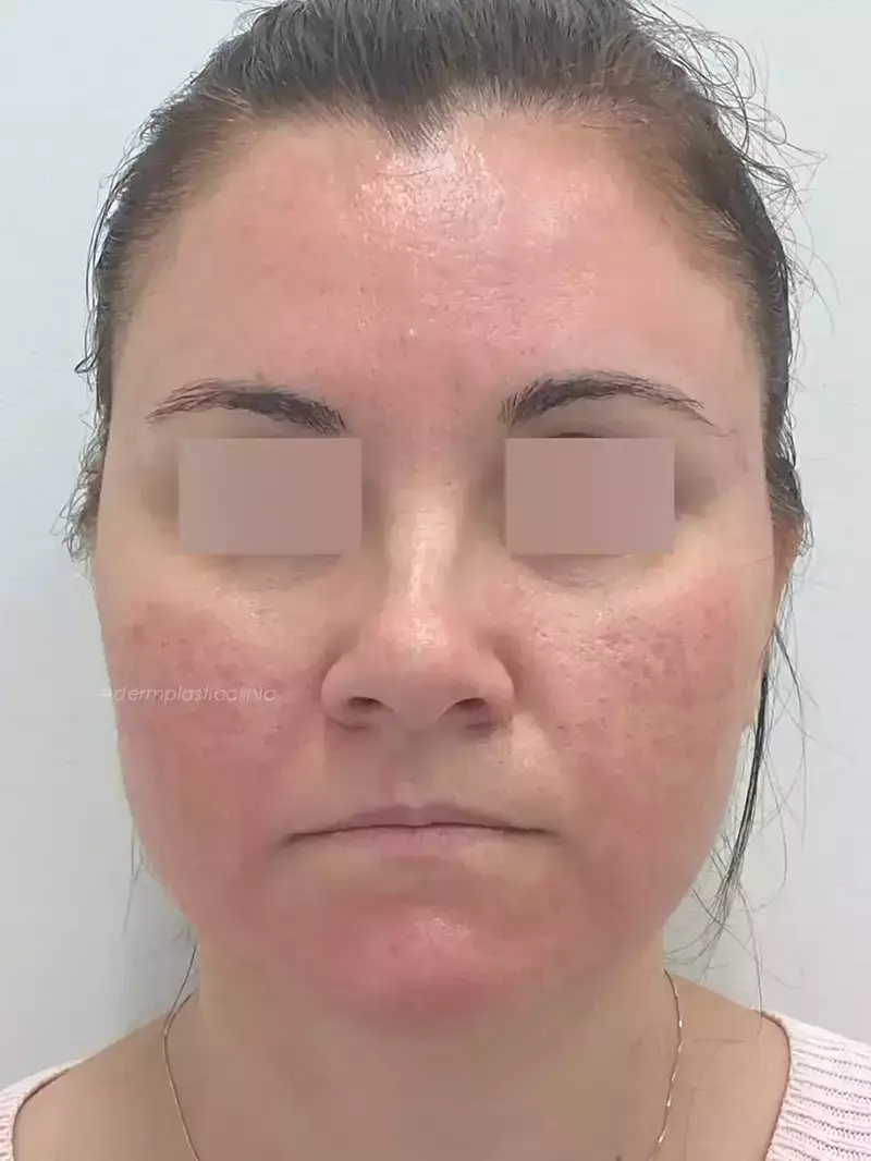 Χημικό Peeling Φωτογραφία Πριν