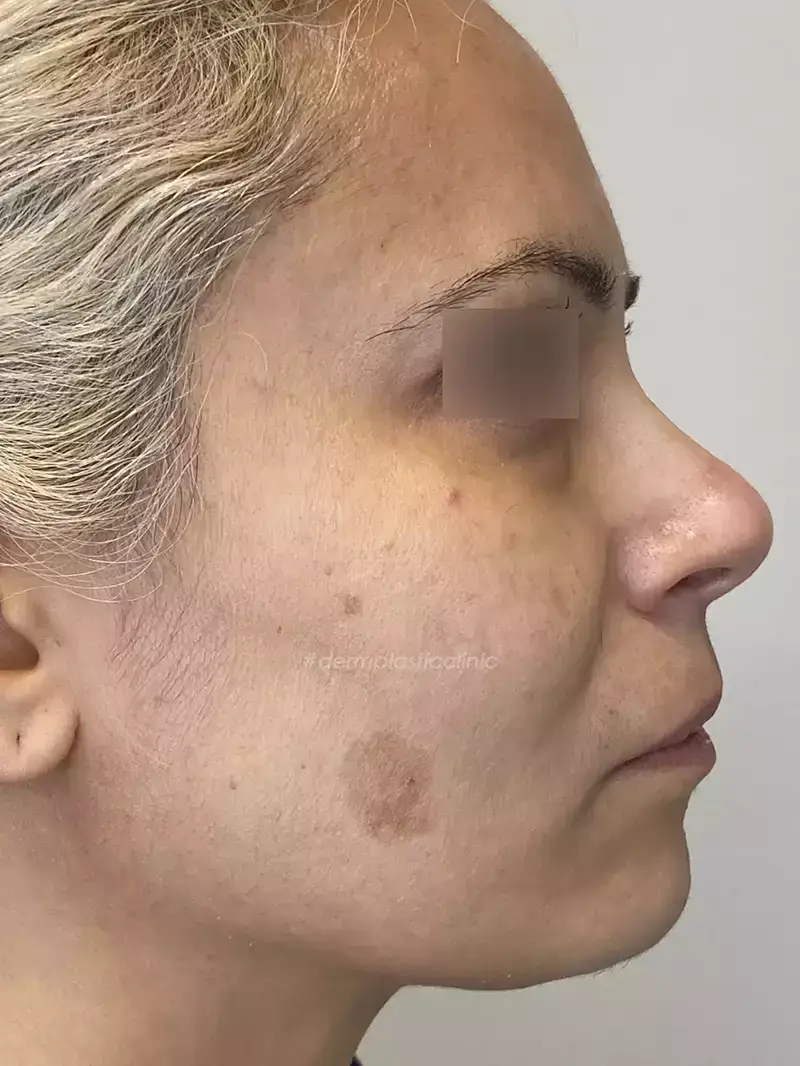 Χημικό Peeling Φωτογραφία Πριν