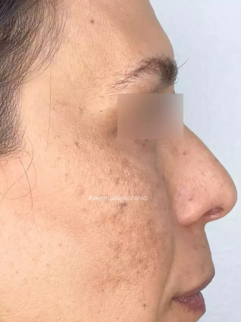 Χημικό Peeling Φωτογραφία Πριν