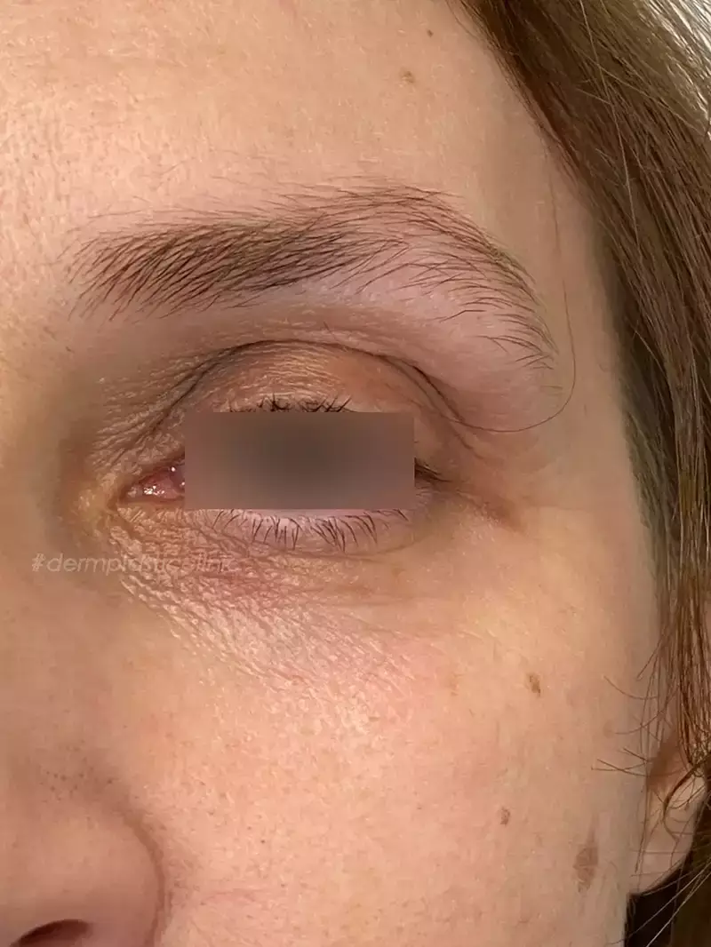 Plexer Plasma Pen Φωτογραφία Μετά