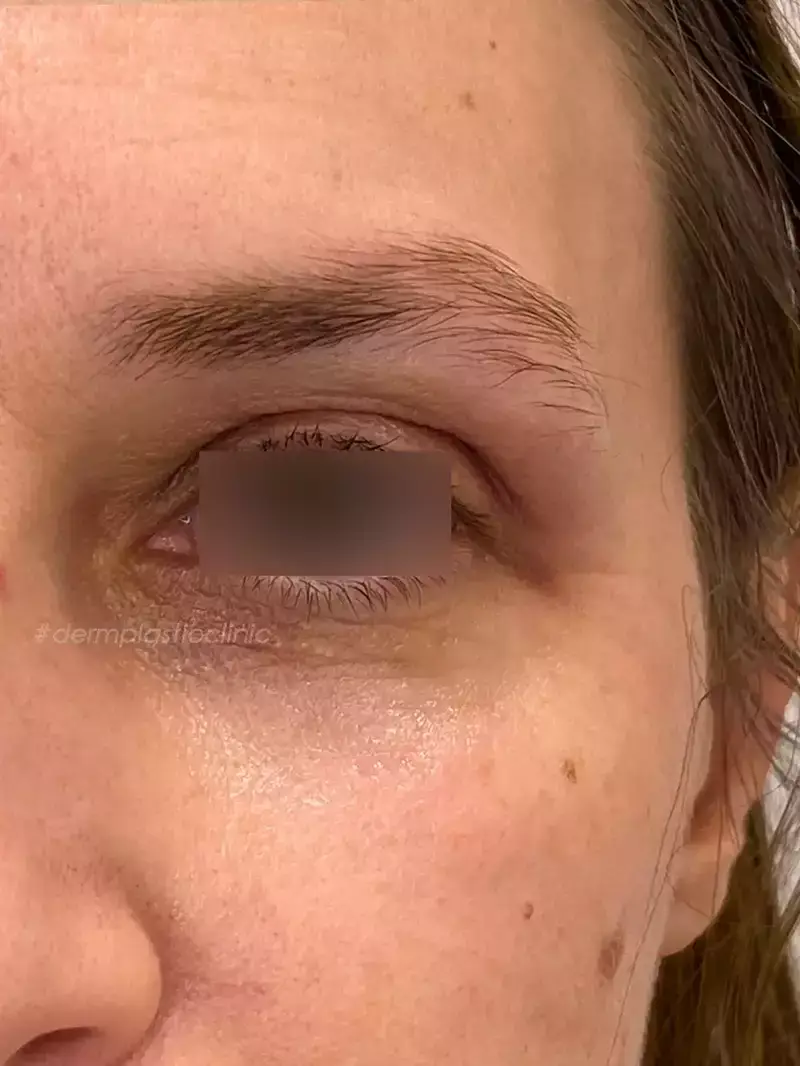Plexer Plasma Pen Φωτογραφία Πριν