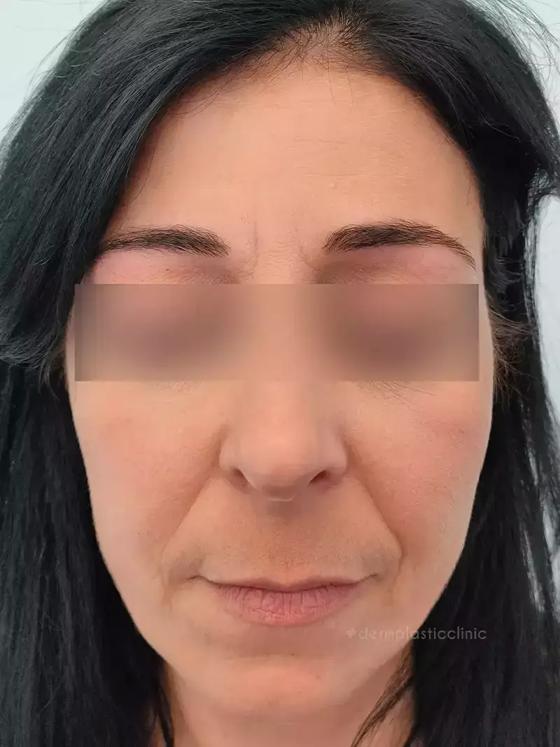 Profhilo Φωτογραφία Πριν τη Θεραπεία