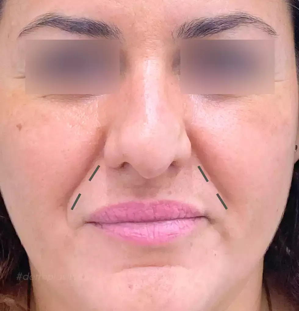 Ρινοπαρειακές Ρυτίδες
