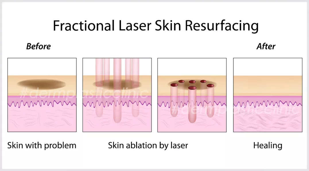 Πως Δρα το Fractional Laser
