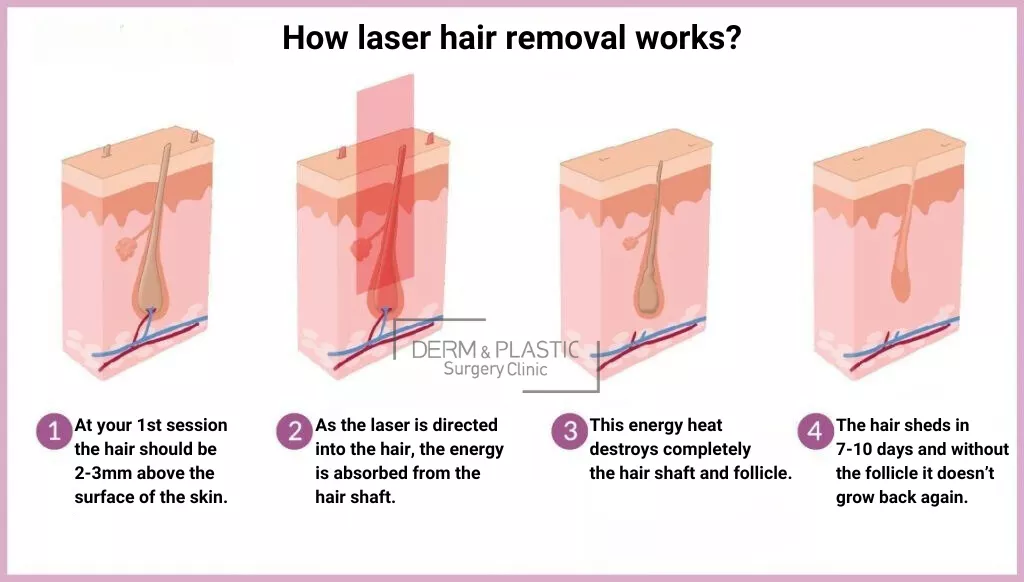 Πως Δρα το Laser Αλεξανδρίτη