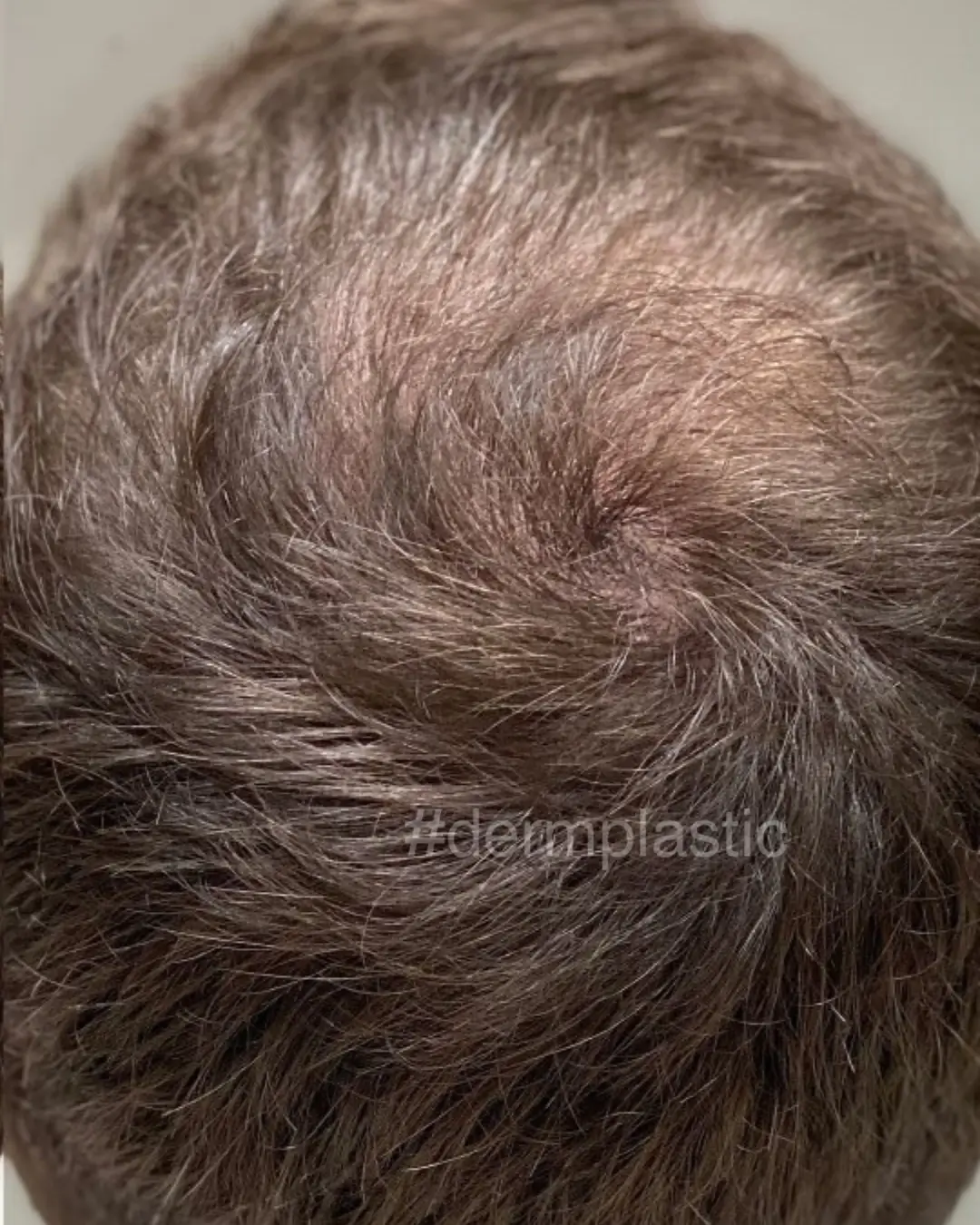 trixoptosi-therapeia-meta-1