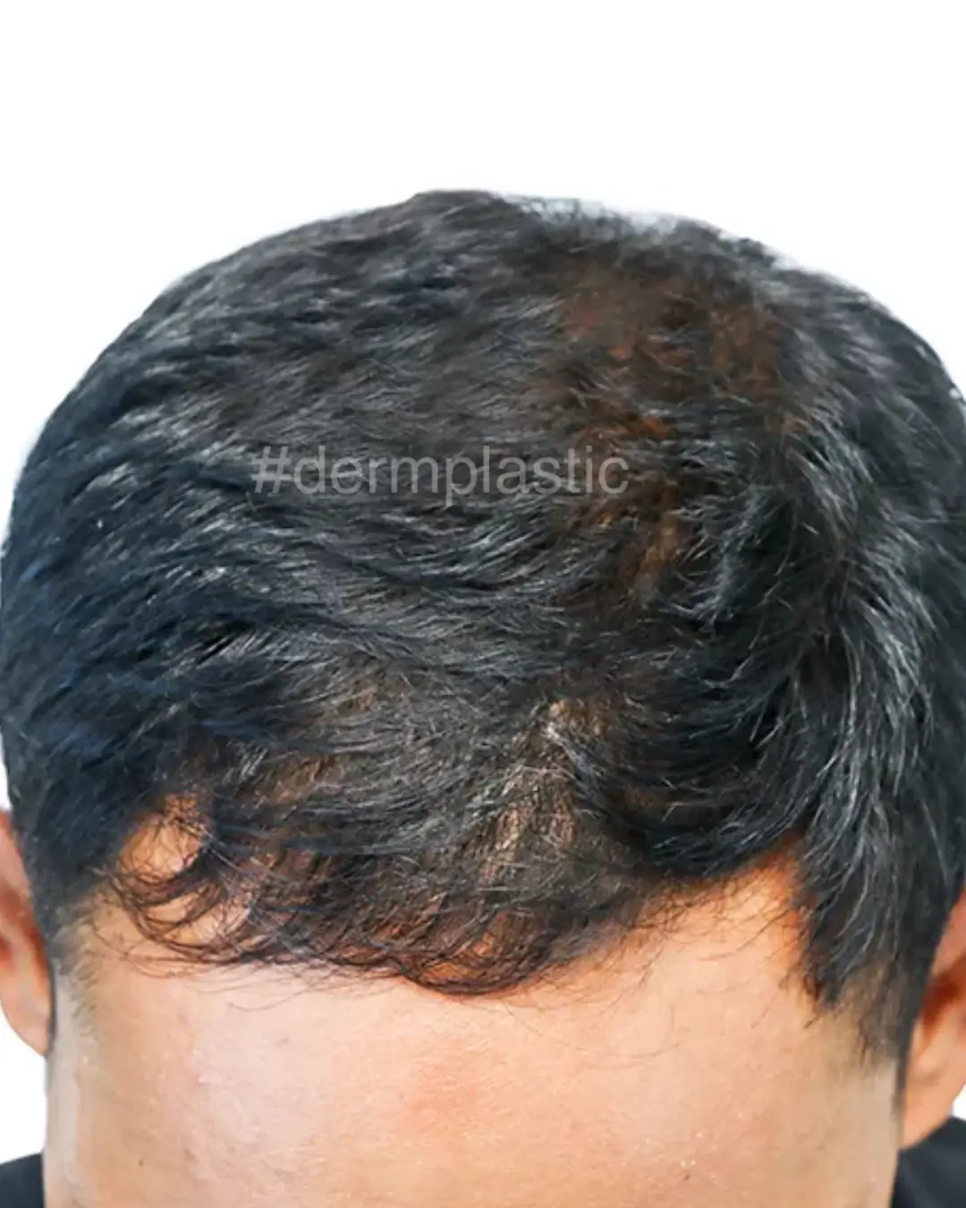trixoptosi-therapeia-meta-3