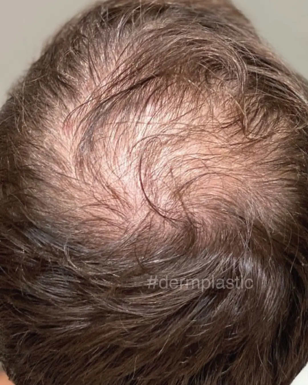 trixoptosi-therapeia-prin-1
