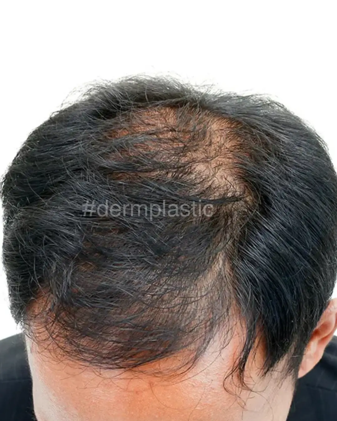 trixoptosi-therapeia-prin-3